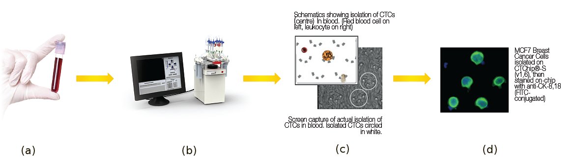 Figure 1: TA cancer patient's blood (a) being processed using the patent-pending microfluidic biochip, CTChip® (b) . Schematic (c) shows how a stiffer and larger CTC is isolated while the more deformable blood cells just squeezed through the cell trap.  Image (d) shows stained breast cancer cells trapped in the biochip. 
