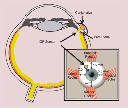 The newly designed IOP sensor is implanted at the pars plana with the implantation tube going through the choroid while the sensing part still remains outside the choroid but under the conjunctiva of the eye.
