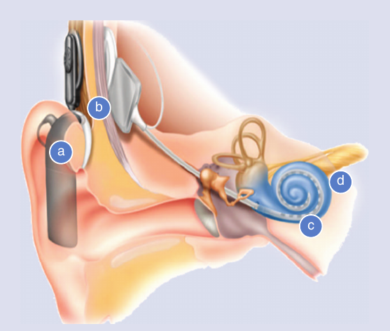 Graphical depiction of the cochlear implant system