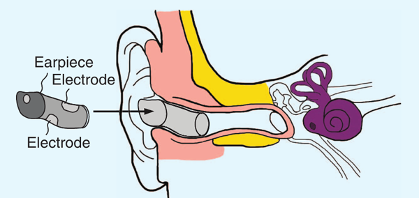 Sketch of a right Ear-EEG earpiece with embedded electrodes shown relative to the ear and ear canal.