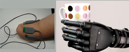 Figure 2: Transradial amputee and the modern prosthetic hand